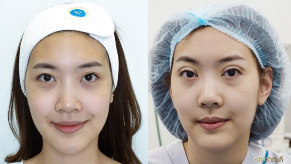 การทำศัลยกรรมตาสองชั้น