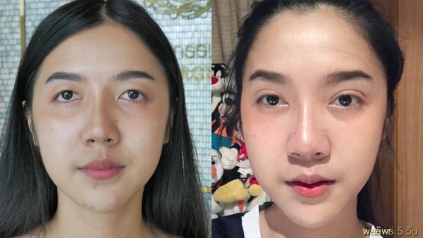 การทำศัลยกรรมตาสองชั้น