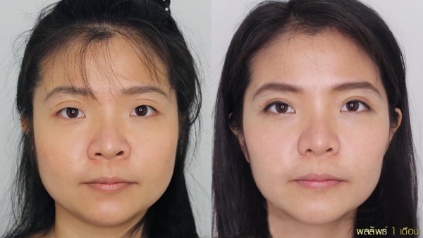 การทำศัลยกรรมตาสองชั้น