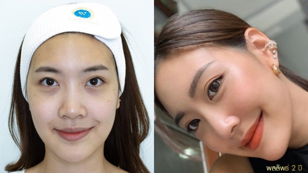 การทำศัลยกรรมตาสองชั้น