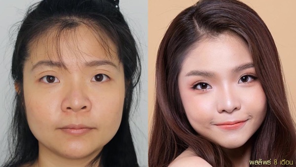 การทำศัลยกรรมตาสองชั้น