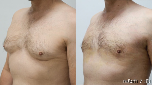 ลดขนาดหน้าอกผู้ชาย