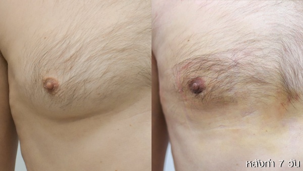 ลดขนาดหน้าอกผู้ชาย