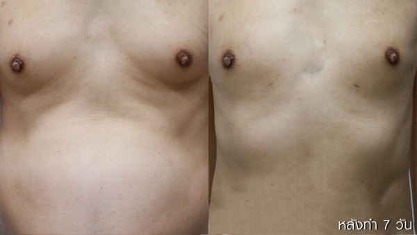 ลดขนาดหน้าอกผู้ชาย