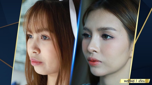 เสริมจมูก