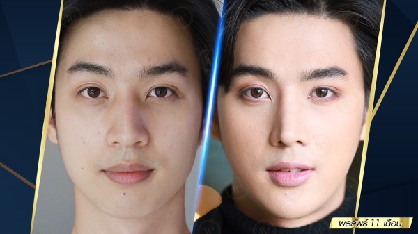 เสริมจมูก