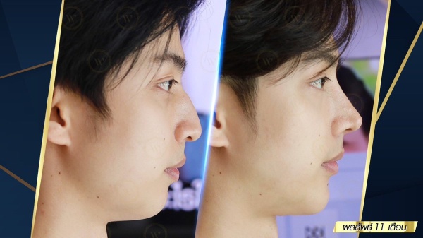 เสริมจมูก