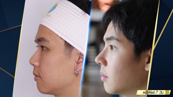 เสริมจมูก