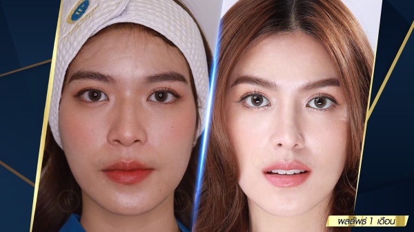 เสริมจมูก