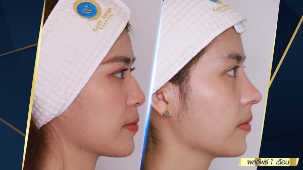 เสริมจมูก