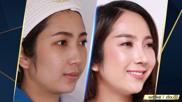 เสริมจมูก