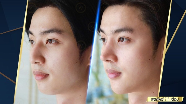 เสริมจมูก