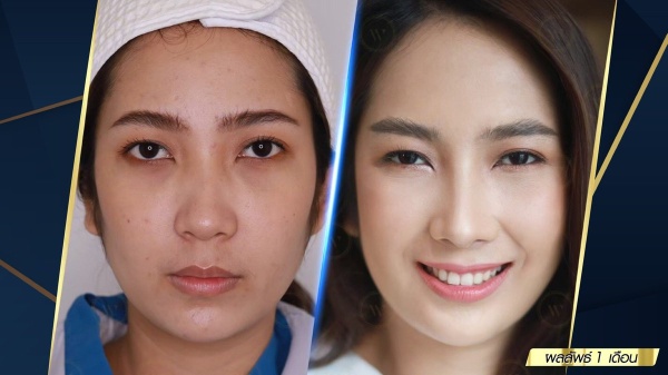 เสริมจมูก