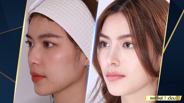 เสริมจมูก