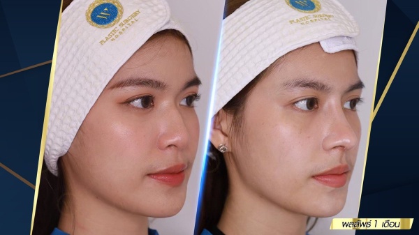 เสริมจมูก