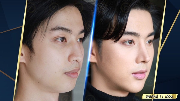 เสริมจมูก