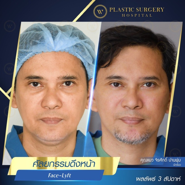 ดึงหน้า