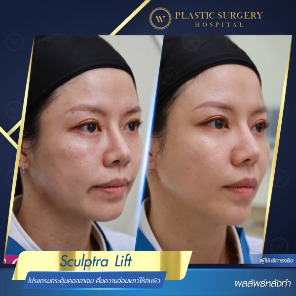 Sculptra Lift