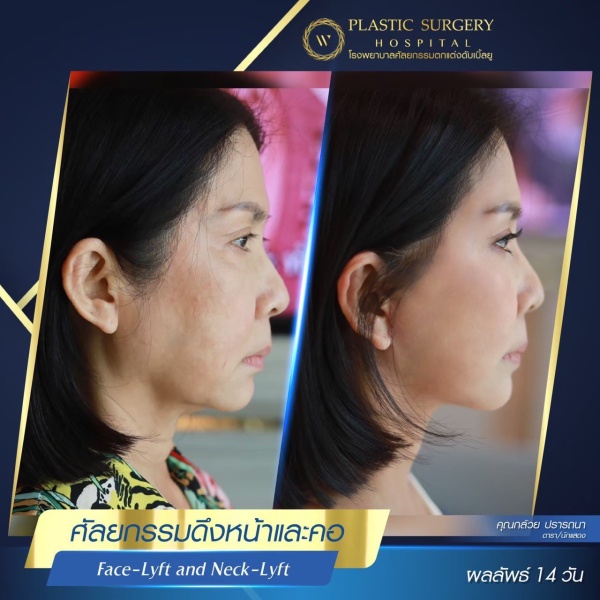 ดึงหน้า