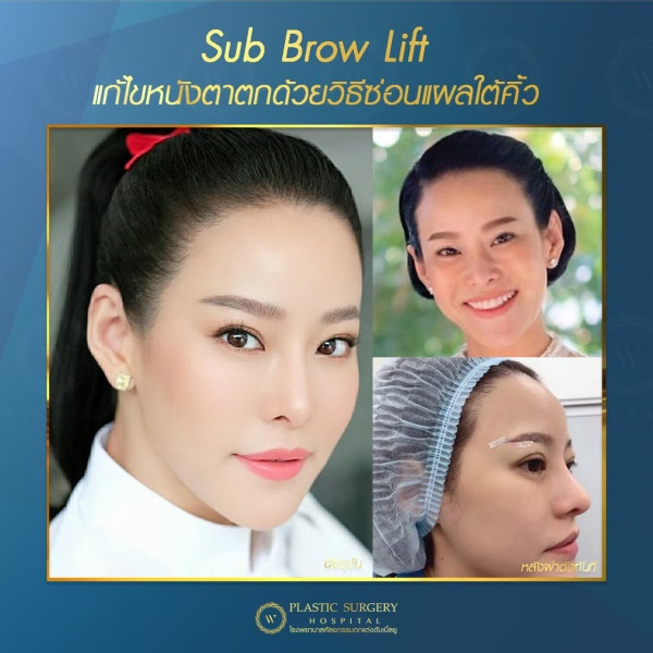 หนังตา/หางตาบนตก