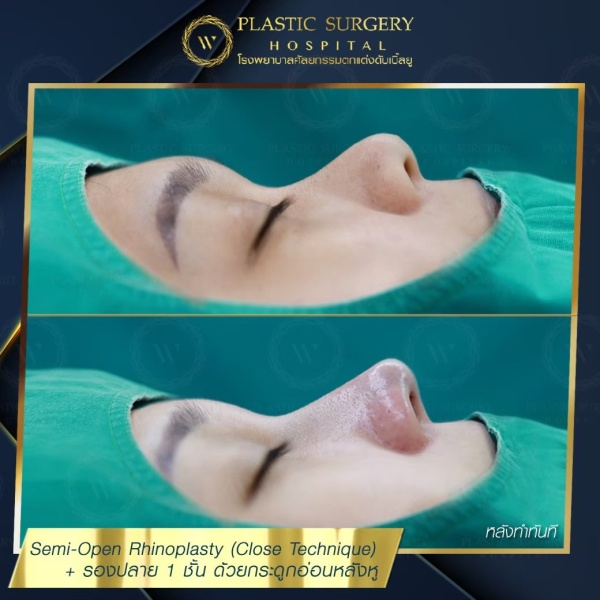 เสริมจมูก