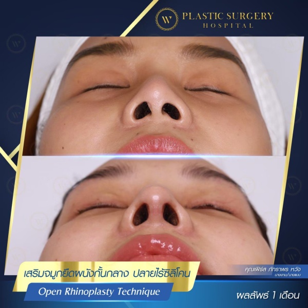 เสริมจมูก