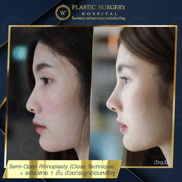 เสริมจมูก