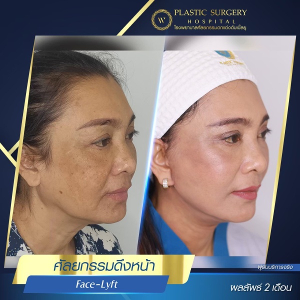 ดึงหน้า