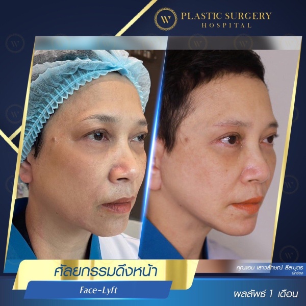 ดึงหน้า