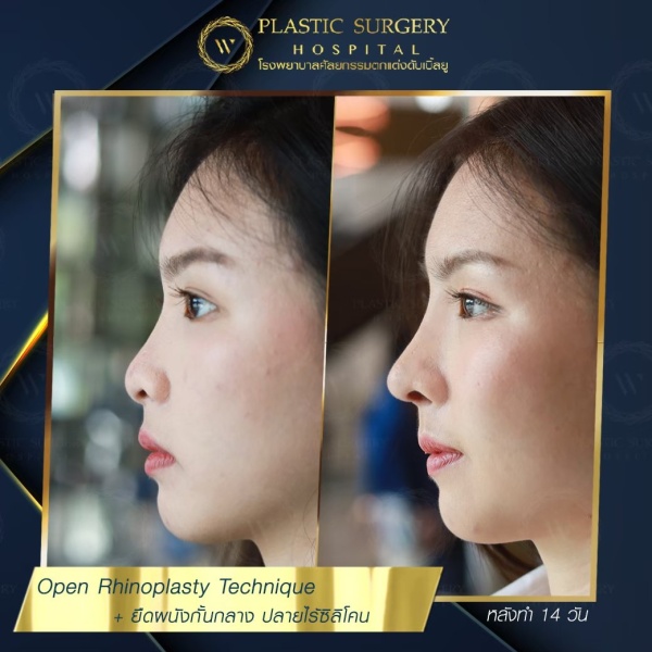 เสริมจมูก