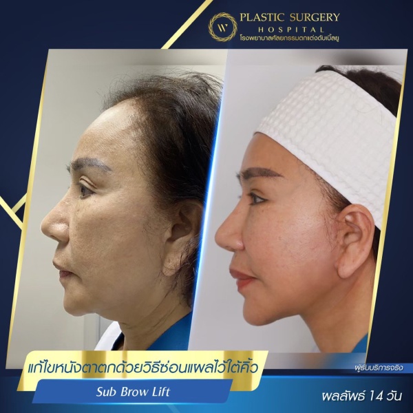 หนังตา/หางตาบนตก