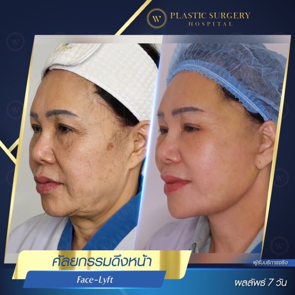 ดึงหน้า