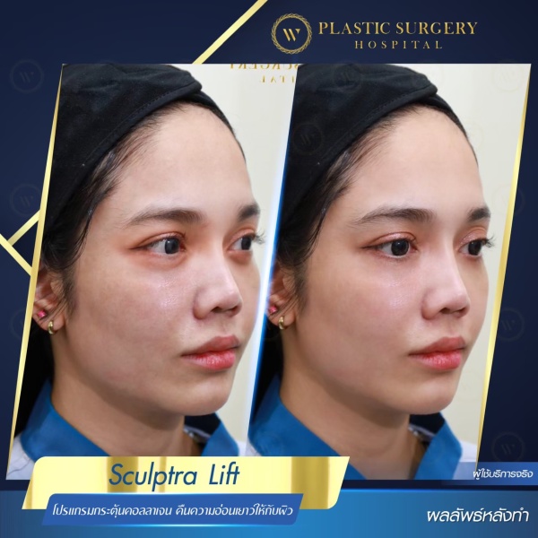 Sculptra Lift