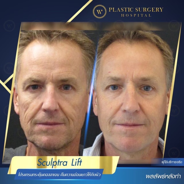 Sculptra Lift