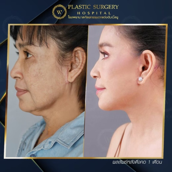 ดึงหน้า