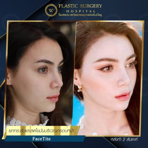 ดูดไขมันเหนียงใต้คาง (FaceTite)