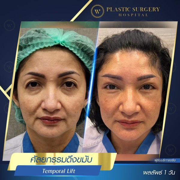 ดึงหน้า