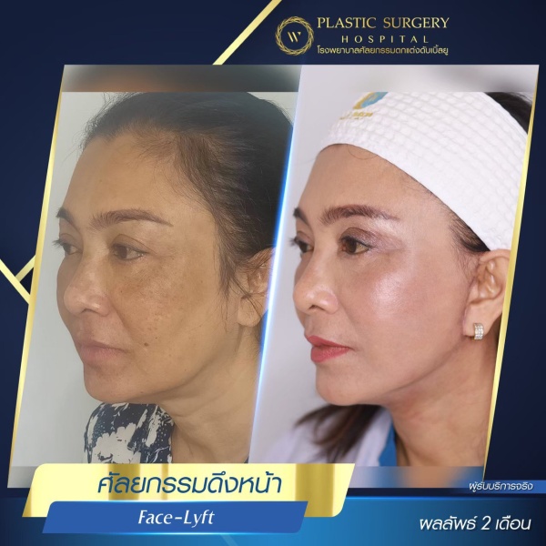 ดึงหน้า