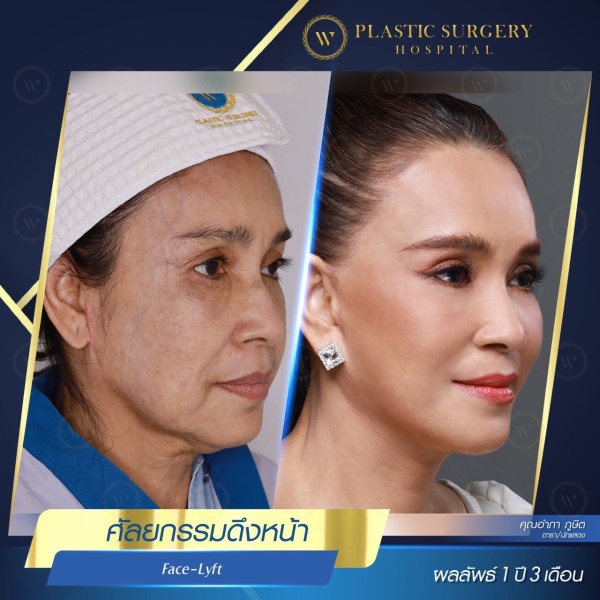 ดึงหน้า