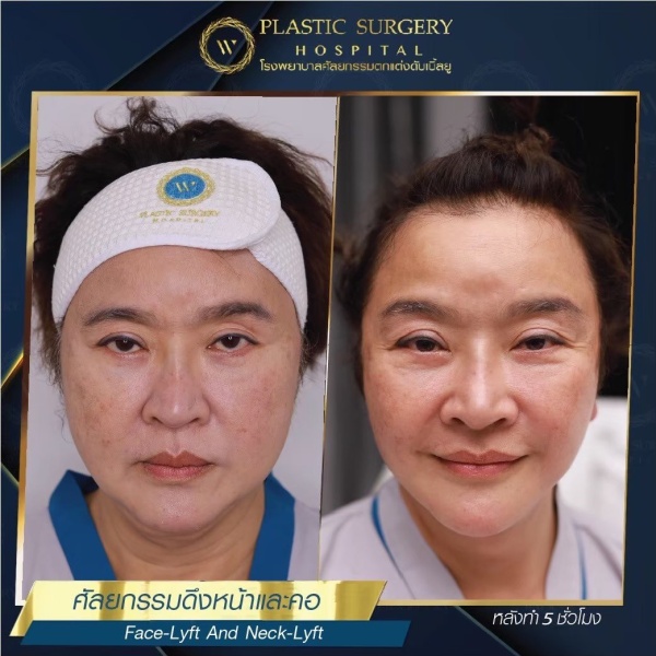 ดึงหน้า