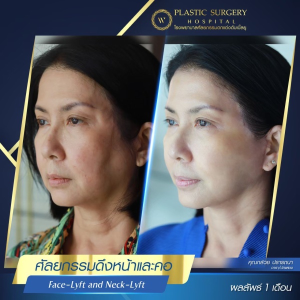 ดึงหน้า