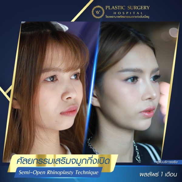 เสริมจมูก