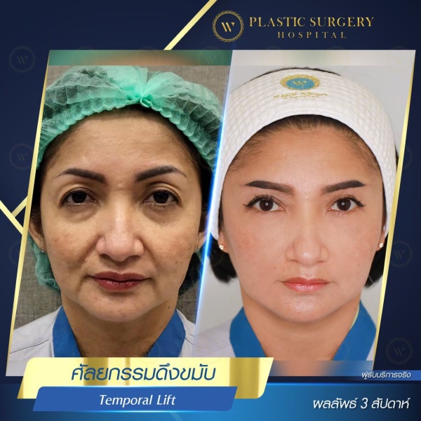 ดึงหน้า