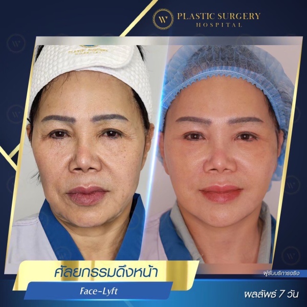 ดึงหน้า