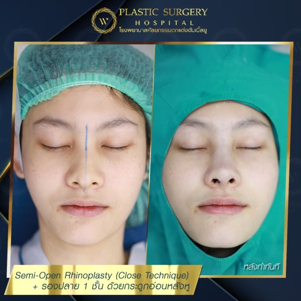 เสริมจมูก