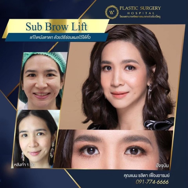 หนังตา/หางตาบนตก