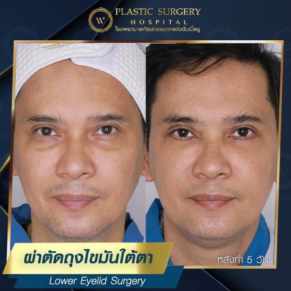 ตัดถุงไขมันใต้ตา