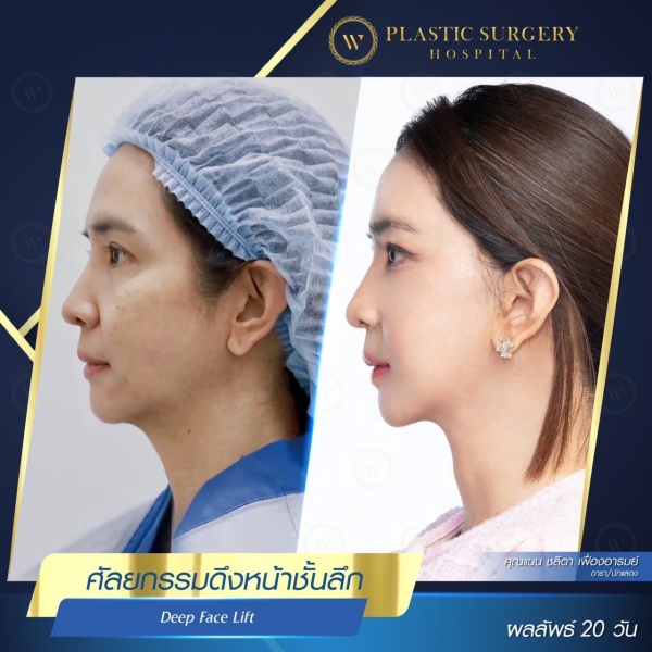 ดึงหน้า