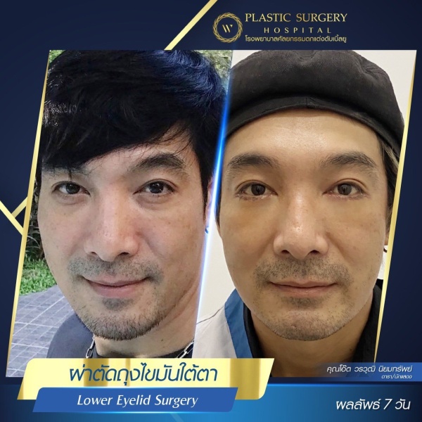 ตัดถุงไขมันใต้ตา