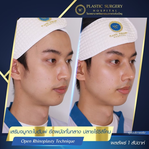 เสริมจมูก